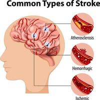 humano con tipos comunes de accidente cerebrovascular vector