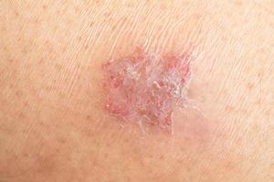 Dermatological skin disease on human skin photo