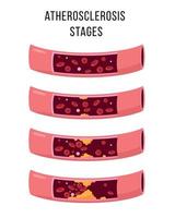 Atherosclerosis stages vector illustration on white background. Healthy and unhealthy arteries. Normal functions, endothelia disfunction, plaque formation, rupture thrombosis.