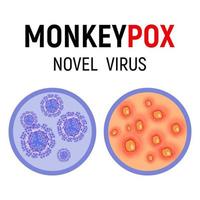 Monkeypox virus cells and human skin with rash, wounds and ulcers on a white background close-up. Monkeypox virus symptom. Vector illustration.