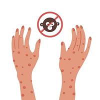 Two Hands with monkeypox virus rashes. Stop new infection. Vector flat illustration isolated.