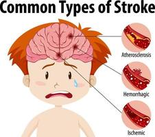 humano con tipos comunes de accidente cerebrovascular vector