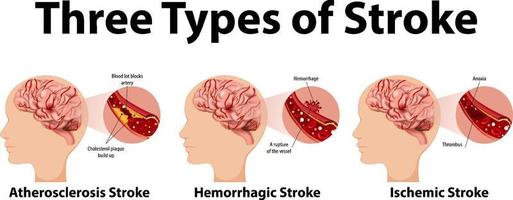 Infographic of common types of stroke vector