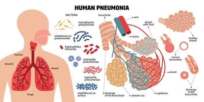 composición infográfica de neumonía humana vector