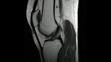 imágenes de resonancia magnética de la articulación de la rodilla imágenes sagitales ponderadas en t1, articulación de la rodilla de resonancia magnética, que muestran la anatomía de la rodilla foto