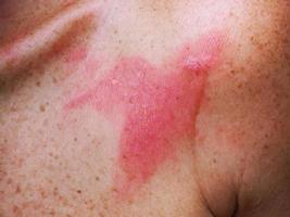 Skin inflammation with ulcer caused by an insect bite, wounds from insect bites has red burns from the virus.soft focus. photo