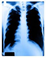 X-Ray Image Of Human Chest photo
