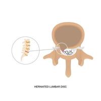 Illustration demonstration of human herniated lumbar disc. vector