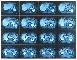 Abdomen MRI scan photo
