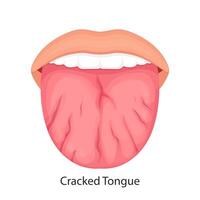 Disease of the tongue, cracks. medical illustration. vector