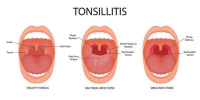 Angina, pharyngitis and tonsillitis. Tonsillitis bacterial and viral. Tonsil infection. Open mouth, anatomy. vector