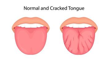 Disease of the tongue, cracks. medical illustration. vector