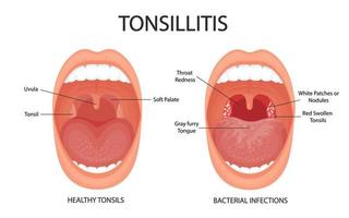 Angina, pharyngitis and tonsillitis. Tonsillitis is bacterial. Tonsil infection. Open mouth, anatomy.