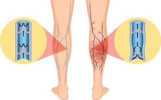 piernas humanas con vena varicosa vector