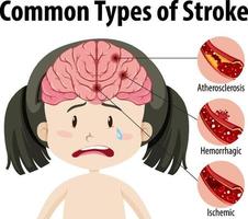 humano con tipos comunes de accidente cerebrovascular vector