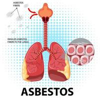 Diagram showing asbestosis in lungs vector