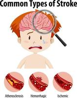 Human with common types of stroke vector