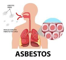 Diagram showing asbestosis in lungs vector