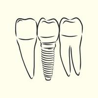 tooth implant vector sketch