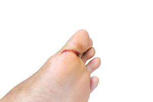 Bleeding on the feet caused by a knife hit, isolated on white background with clipping path. photo