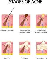 Stages of acne formation in the human skin vector