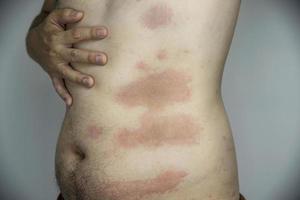 Man getting red skin rash at his body part - people with skin allergy problem concept photo