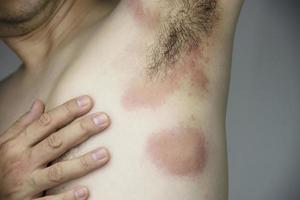 Man getting red skin rash at his body part - people with skin allergy problem concept photo