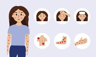 Monkeypox virus symptoms illustration with woman character. Monkeypox outbreak concept by world health organization with examples and explanation. vector