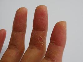 peeling finger skin on focus background photo