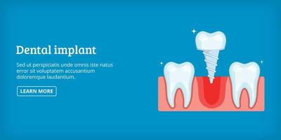 Dental implant banner horizontal, cartoon style vector