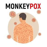 Man sick with monkey smallpox in flat style isolated on white background. Background with monkey pox virus. Vector illustration.