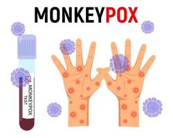 Monkey pox background. A test tube with blood for a test and a human hand with a rash and ulcers surrounded by viral cells on a white background. Disease symptoms. Vector illustration.