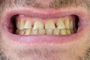 feos dientes de hombre, torcidos y sucios. odontología foto