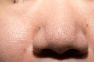 Pimples, clogged acne around the nose of men photo