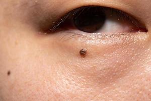 mole under the eyes of a man, pigmentation on the face photo