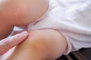la madre aplica crema antialérgica en la rodilla del bebé con erupción cutánea y alergia con mancha roja causada por picadura de mosquito foto