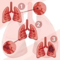 infografía del sistema pulmonar, estilo de dibujos animados vector