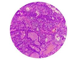 Thyroid cancer, Microscopic image of Metastatic papillary carcinoma of thyroid, central lymph node. photo