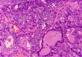 Thyroid cancer, Microscopic image of Metastatic papillary carcinoma of thyroid, central lymph node. photo