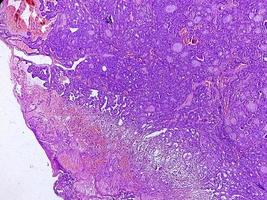 Thyroid cancer, Microscopic image of Metastatic papillary carcinoma of thyroid, central lymph node. photo