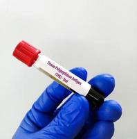 Tissue polypeptide antigen or TPA test for the diagnosis of urogenital cancer or bladder cancer photo