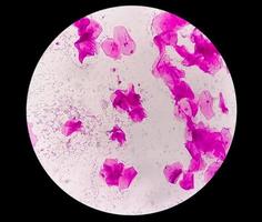 Gram staining, also known as Gram's method, is a method of differentiating bacterial species into two large groups called Gram positive and Gram negative. photo