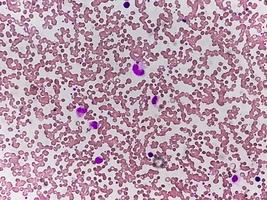 Photomicrograph or microscopic image showing Hemoglobin D trait with iron deficiency anemia. photo