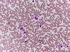 fotomicrografía o imagen microscópica que muestra el rasgo de hemoglobina d con anemia por deficiencia de hierro. foto