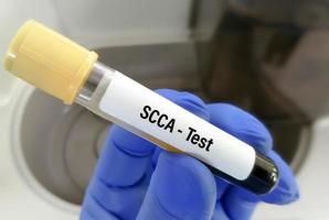 Squamous cell carcinoma antigen or SCCA testing for the diagnosis of squamous cell carcinoma. tumor marker for squamous cell cancer. photo