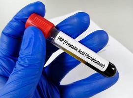 Blood sample for prostatic acid phosphatase test in laboratory for prostate cancer diagnosis. photo