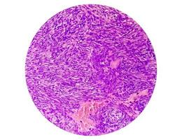 microfotografía de un schwannoma, un tumor benigno de tejido blando de la vaina del nervio periférico. foto
