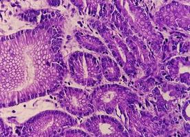 Photomicrograph or microscopic image of Stomach cancer. Adenocarcinoma of stomach photo