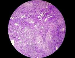 Photomicrograph or microscopic image of Stomach cancer. Adenocarcinoma of stomach photo