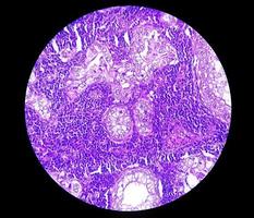 fotomicrografía o imagen microscópica del cáncer de estómago. adenocarcinoma de estómago foto